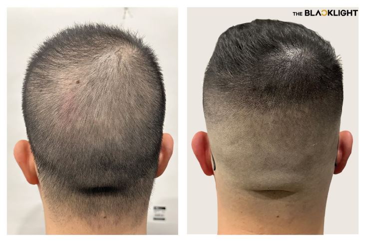 탈모 고민 끝! 두피문신으로 내 삶에 찾아온 놀라운 변화 - CKNNews 이미지